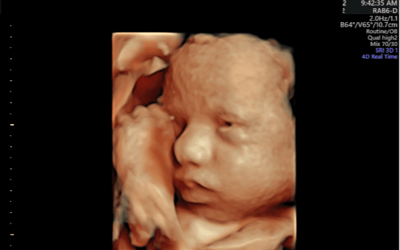 Pregnancy Ultrasound Image Gallery - 25 - 32 Weeks